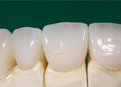 امکان ساخت دندان های سرامیکی در کشور فراهم شد