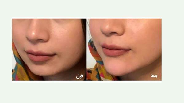زاویه دار کردن چانه چگونه است؟