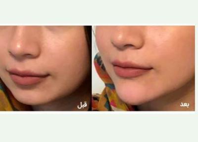 زاویه دار کردن چانه چگونه است؟